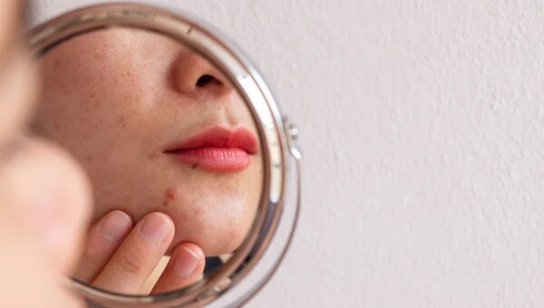 Skin Health and Acne Management